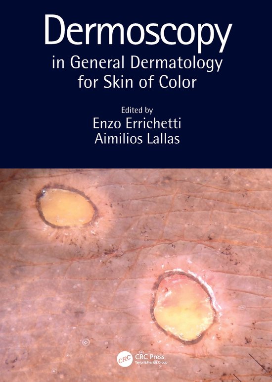 Dermoscopy in General Dermatology for Skin of Color