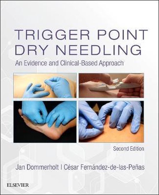 Trigger Point Dry Needling