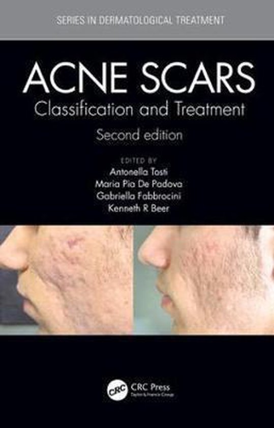 Acne Scars