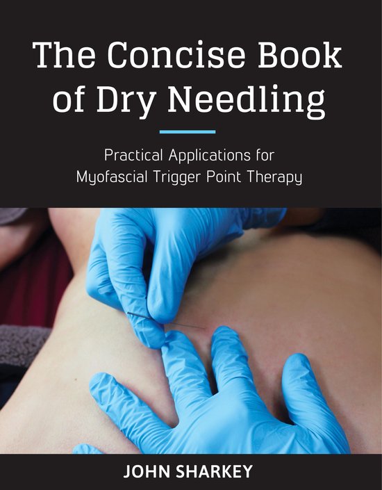 The Concise Book of Dry Needling