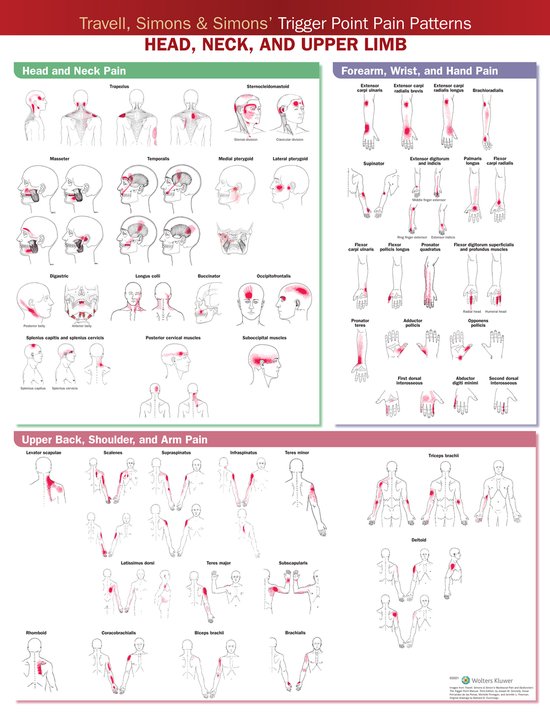 Travell, Simons & Simons’ Trigger Point Pain Patterns Wall Chart - Hoofd, nek en bovenste ledematen