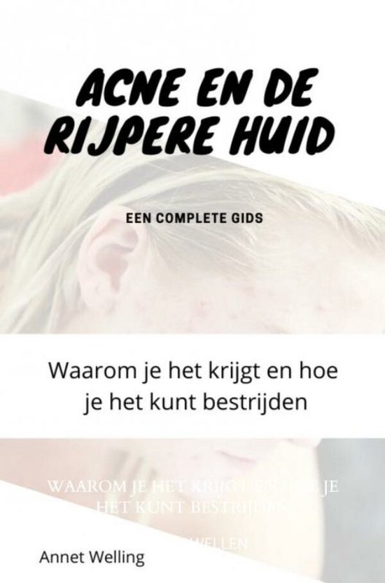 Acne bij volwassenen